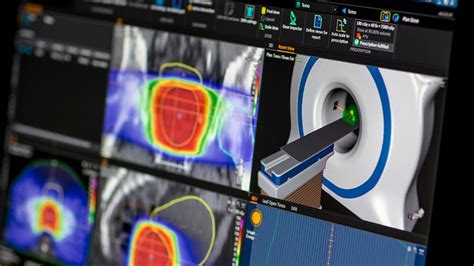 raysearch|raystation treatment planning system.